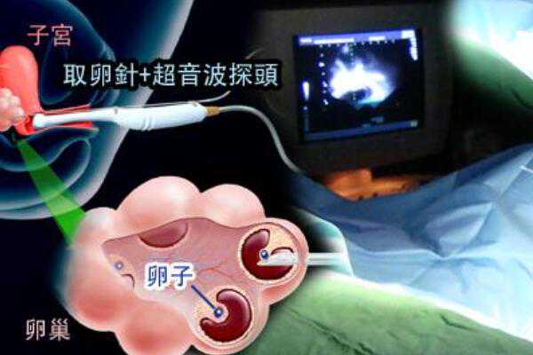 借卵代生子[广州传承助孕可信],大庆油田乘风医院可以做三代试管婴儿吗？